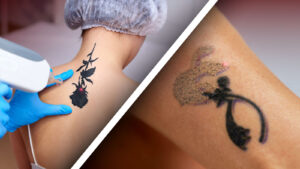 Was ist Laser-Tattoo-Entfernung?